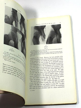 Contributions to the Knowledge of Congenital Dislocation of the Hip Joint: Late Results of Closed Reduction and Arthographic Studies of Recent Cases
